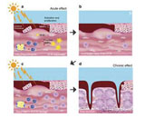 Skin Photoaging (SP)