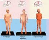 Spastic Cerebral Palsy (SCP)