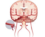 Subarachnoid Hemorrhage (SH)