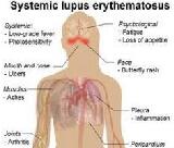 Systemic Lupus Erythematosus (SLE)