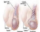 Testicular Sarcoidosis (TS)