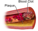 Autologous Thrombus (AT)