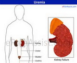 Uremia