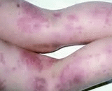 Vasculitis