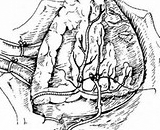 Vein Bridge Stenosis (VBS)