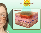 Melasma