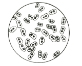 Streptococcus Pneumoniae (SP)