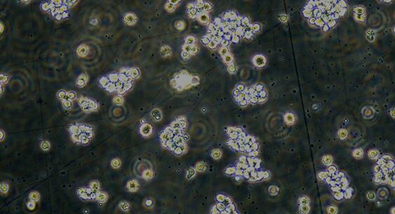 Human T-lymphoblastic Leukemia (TLL)