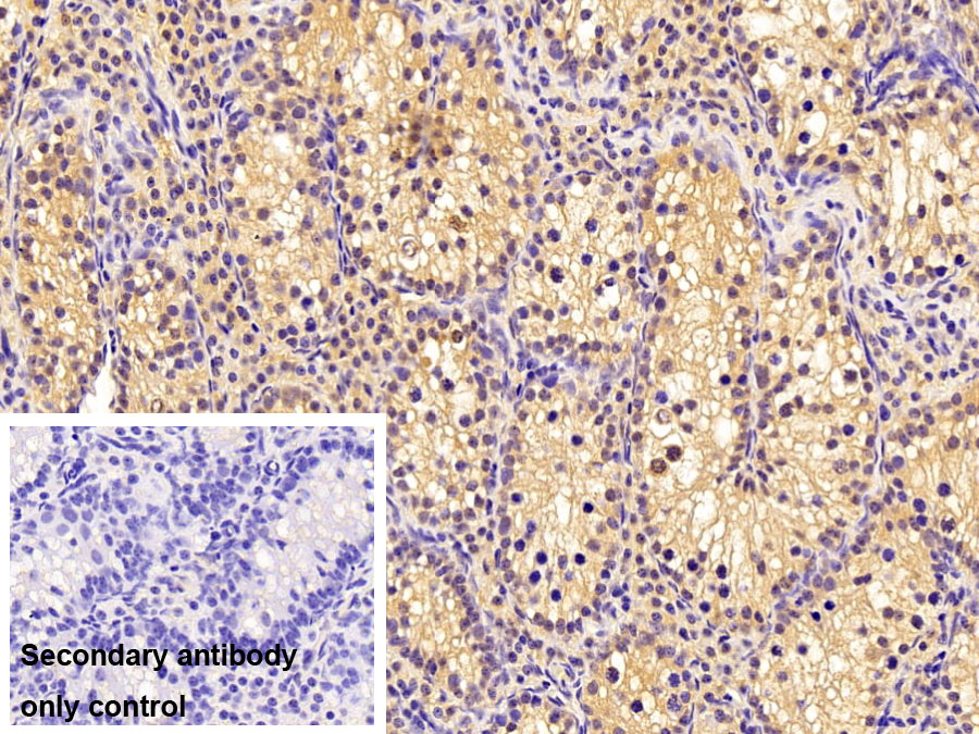 Polyclonal Antibody to O-6-Methylguanine DNA Methyltransferase (MGMT)